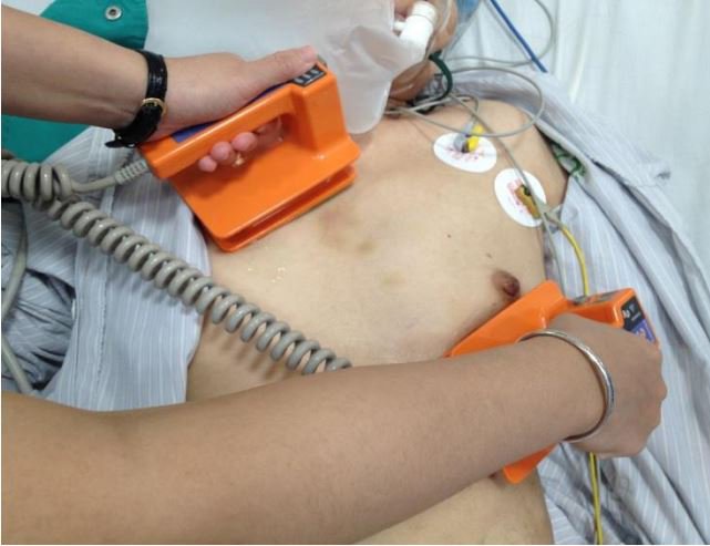 Chỉ định sốc điện cấp cứu ở các bệnh nhân có rôi loạn nhịp thất kéo dài kèm theo dau ngực, suy tim, hạ HA